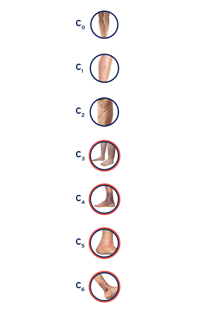 Feet and legs showing the clinical stages of chronic venous disease, from no visible signs (C0) to active venous ulcers (C6). Feet and legs showing the clinical stages of chronic venous disease, from no visible signs (C0) to active venous ulcers (C6).